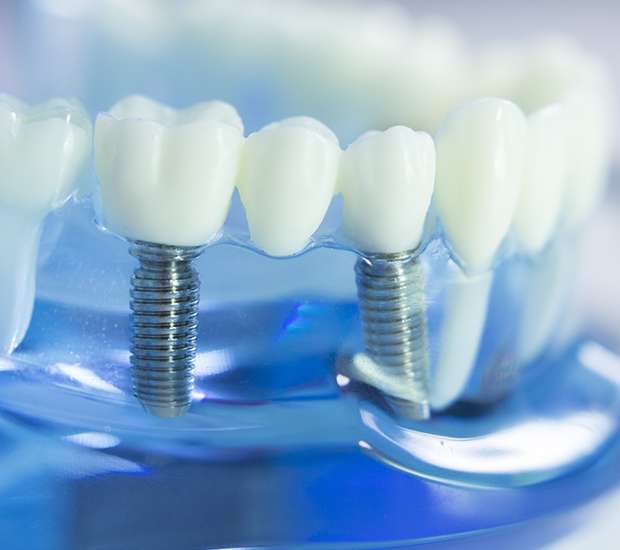 West Linn Dental Implants