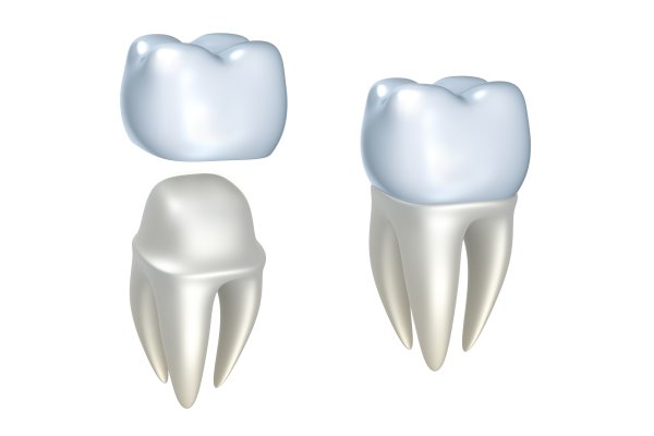 dental implants West Linn, OR